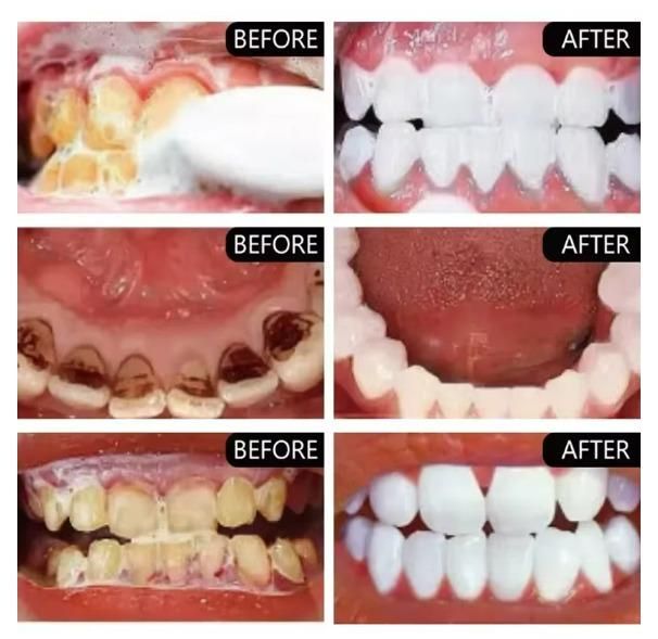 SP-4 Ultra+ Whitening Teeth – Buy 1 Get 1 Free (Pack of 2)