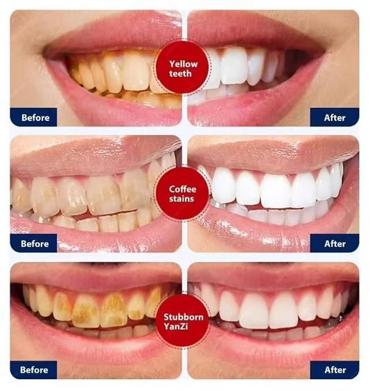 SP-4 Ultra+ Whitening Teeth – Buy 1 Get 1 Free (Pack of 2)